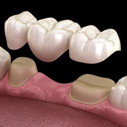 A 3D illustration of a dental bridge