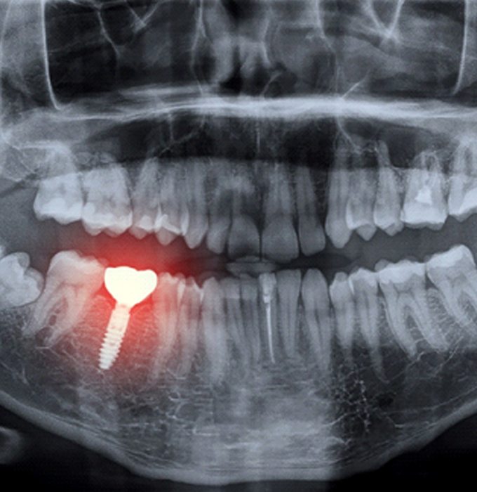 X-ray of a failing dental implant in Barton City