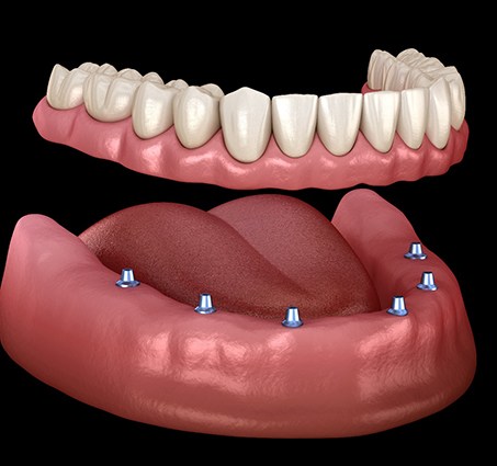  implant denture in Barton City on the lower arch 