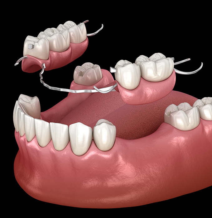 Aniamted partial denture placement