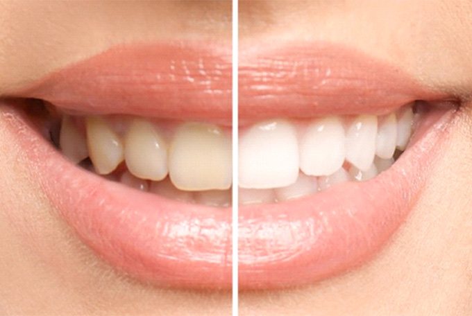 a before-after photo of a whitening smile
