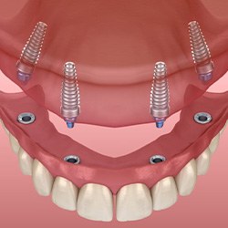 Illustration of implant dentures for upper arch