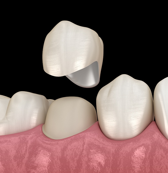 Animated dental crown placement