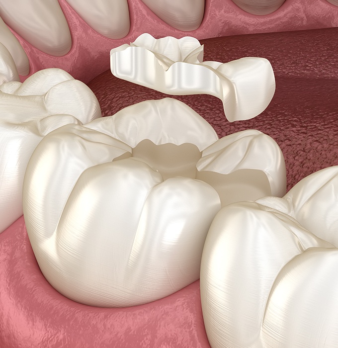 Animated tooth colored filling placement