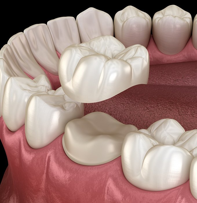 Illustration of dental crown in Barton City being placed on tooth