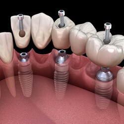 A 3D illustration of an implant bridge based on three implants