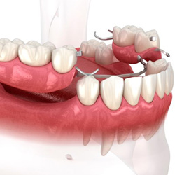 Illustration of partial denture for lower dental arch