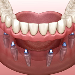 Illustration of implant dentures for lower dental arch