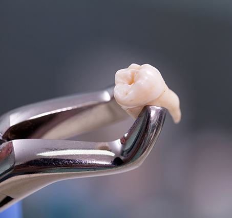 Metal clasp holding extracted tooth