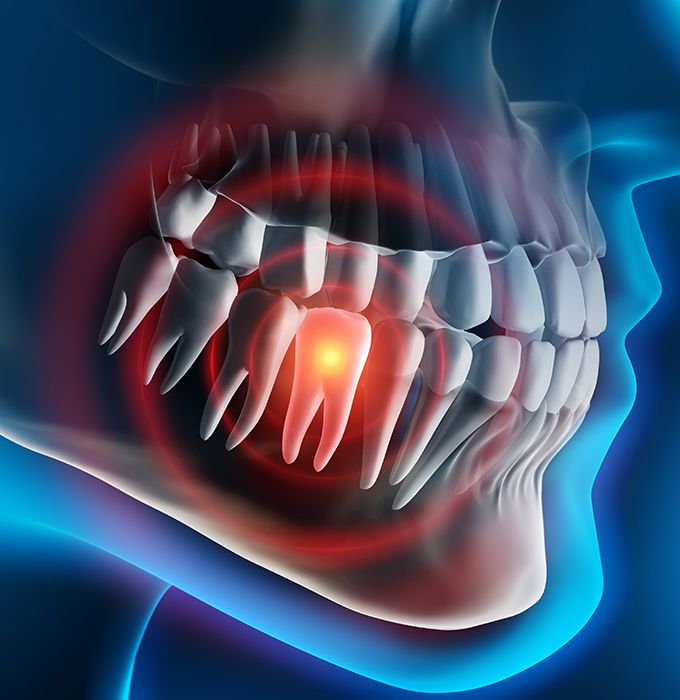 3 D rendering of damaged tooth before extraction
