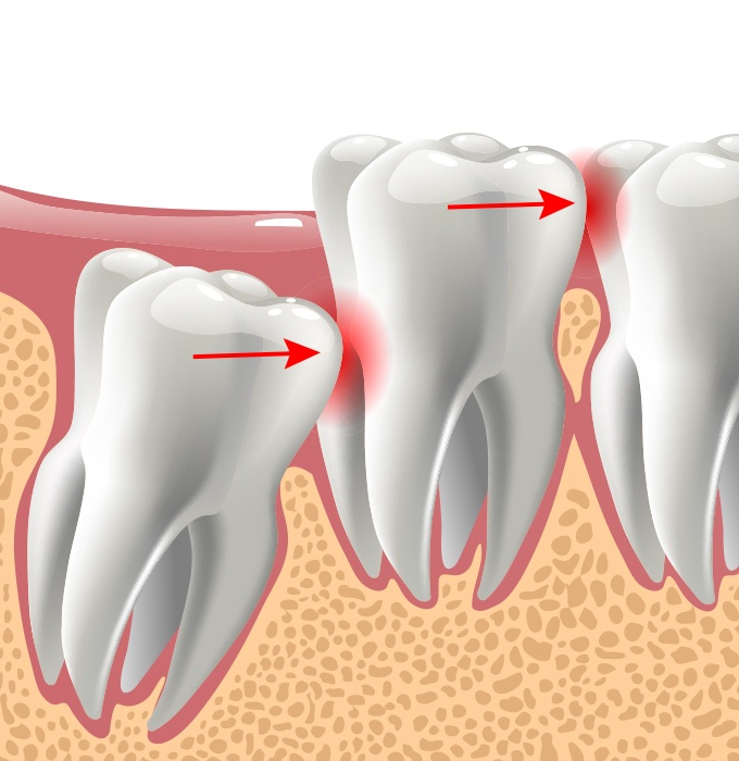 Animated smile with impacted wisdom tooth