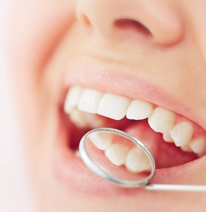 Close-up of smile with mirror showing backside of teeth