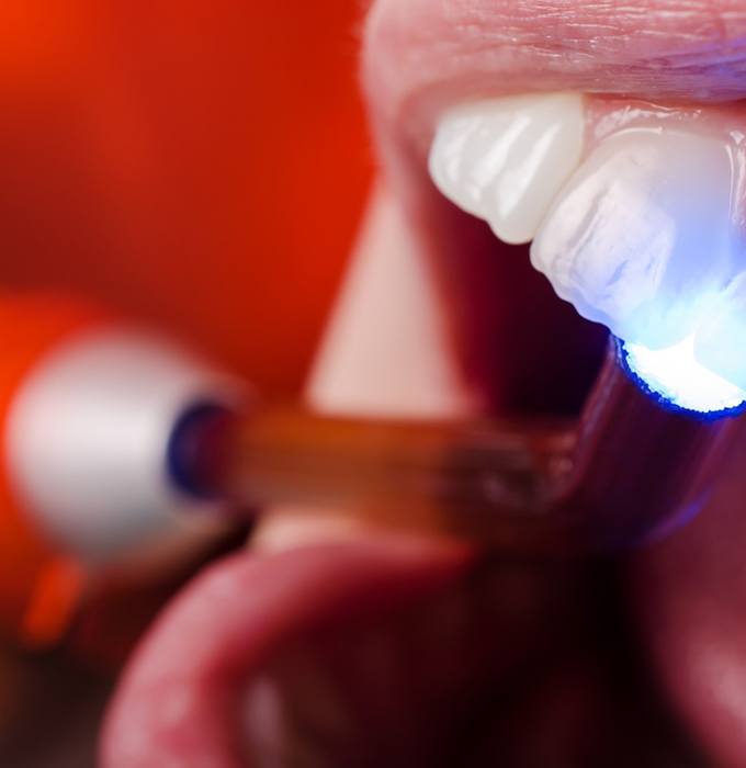 Curing light hardening tooth-colored filling