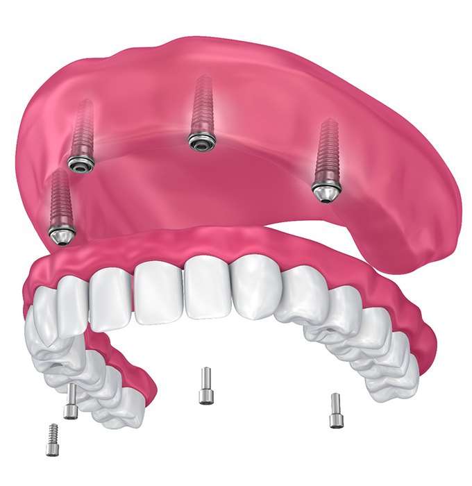 full implant denture on the upper arch 