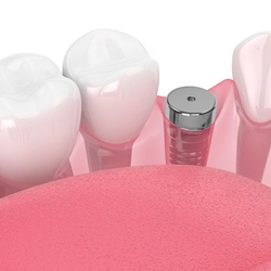 Model of dental implant in Barton City, MI with protective cap