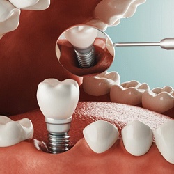 Dental implant in Barton City, MI with crown inserted into jaw