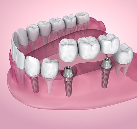 Animated dental implant supported fixed bridge placement