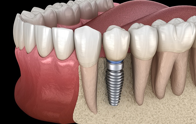 Animated dental implant supported dental crown placement