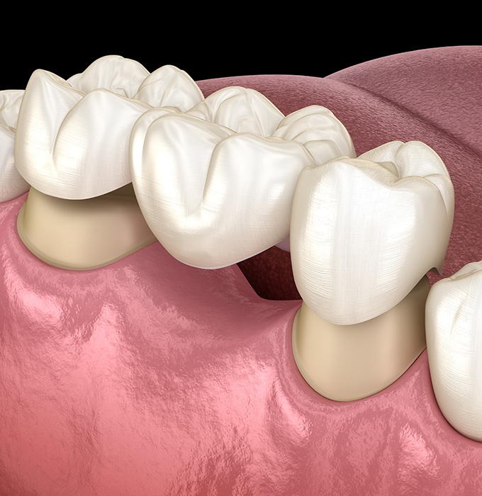 Animated dental bridge placement