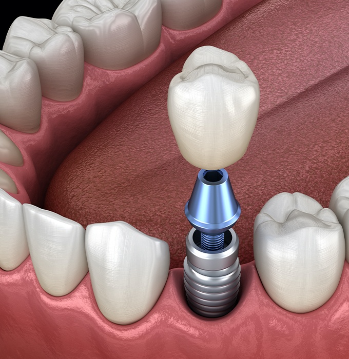 Animated dental implant supported dental crown placement