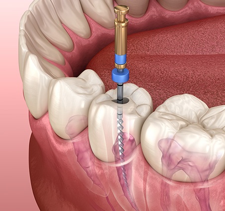 Animated root canal therapy process