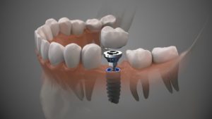 dental implants illustration 