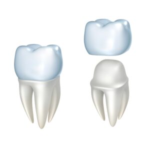 Model of dental crown procedure