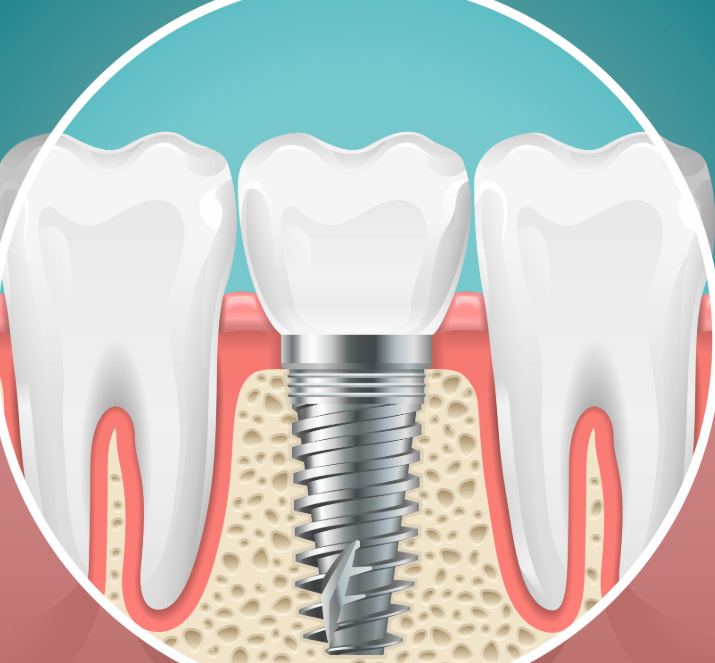 Illustrated cross section of a dental implant